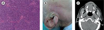 Case Report: Exceptional Response to Avelumab After Failure of Electrochemotherapy in a Patient With Rapidly Progressive, PD-L1-Negative Merkel Cell Carcinoma